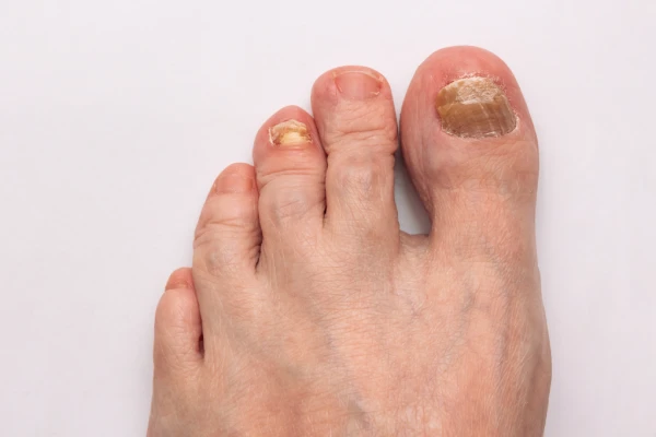 Efectividad del tratamiento láser para hongos en uñas